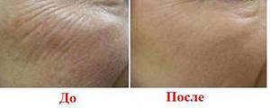 Прем'єр - клініка естетичної медицини - лазерне омолодження шкіри обличчя