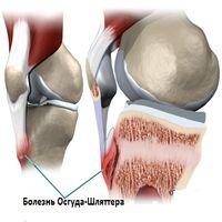 Причини гемортроз колінного суглоба, наслідки і пункція як метод лікування