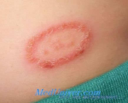 Cauze și mecanisme ale infecțiilor fungice ale pielii