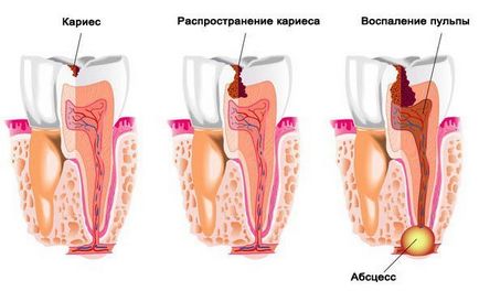 профілактика карієсу