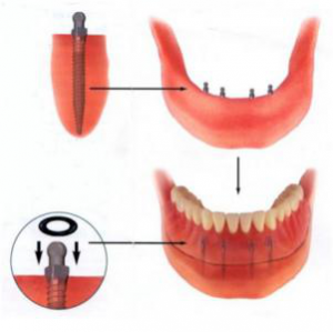 Protetica stomatologică cu absența completă a dentiției