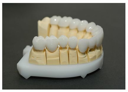 Протезування зубів у Володимирі, види і ціни, протезування зубів з гарантією недорого
