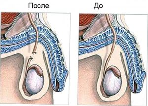 Contraceptive pentru bărbați - tablete, geluri, injecții, injecții