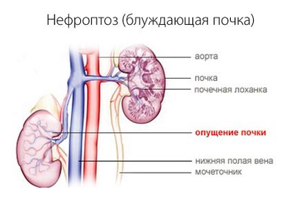 Sunt tratamente pentru remediile populare de nefroptoză