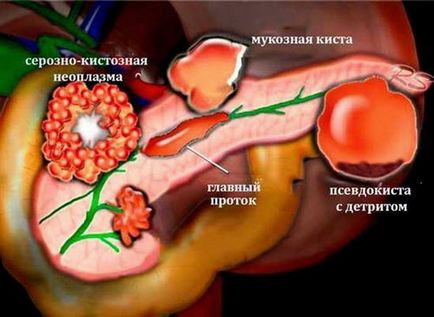 Психосоматика небезпечних захворювань підшлункової залози, панкреатит