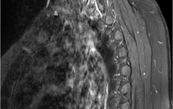 Cancerul simptomelor maduvei spinarii, diagnosticul, tratamentul, reabilitarea