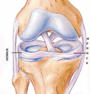 Ruptura meniscului medial (tipuri, simptome, diagnostic și tratament)