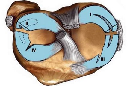 Ruptura meniscului medial (tipuri, simptome, diagnostic și tratament)