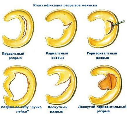 Ruptura meniscului medial (tipuri, simptome, diagnostic și tratament)