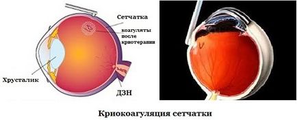 Розрив сітківки ока