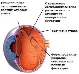 Розрив сітківки ока