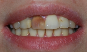 Реставраційне відбілювання зубів в спб недорого