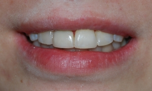 Реставраційне відбілювання зубів в спб недорого