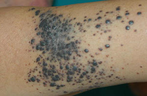 Recurența melanomului după îndepărtare și cauza sa