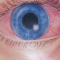 роговицата белег око и методи за лечение,