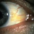 szaruhártya heg szem és a kezelési módszerek