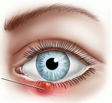 Simptomele orzului intern ca tratament, diagnostic