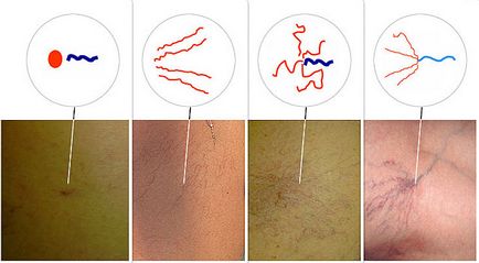 Asterixul vascular de cauză și prevenire