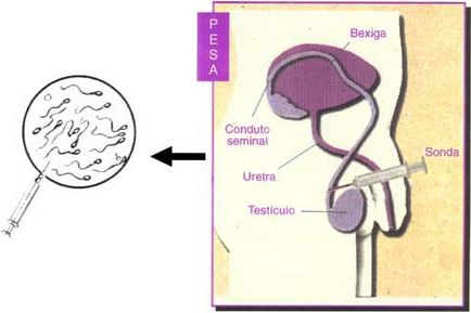 Metode de fertilizare în absența spermei