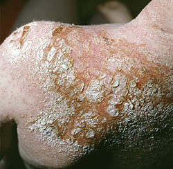 Streptodermia - cauze, simptome, diagnostic și tratament