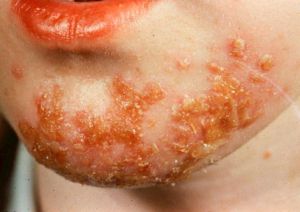 Streptoderma - cauze, simptome și remedii folclorice pentru streptoderma