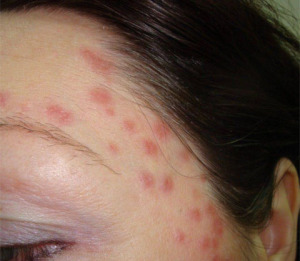 Streptoderma - cauze, simptome și remedii folclorice pentru streptoderma