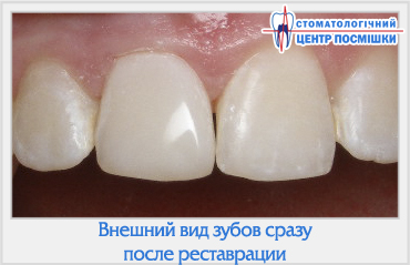 Proprietatea fluorescenței unui dinte restaurat