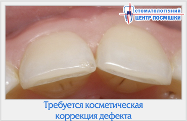 Властивість флуоресценції реставрованого зуба