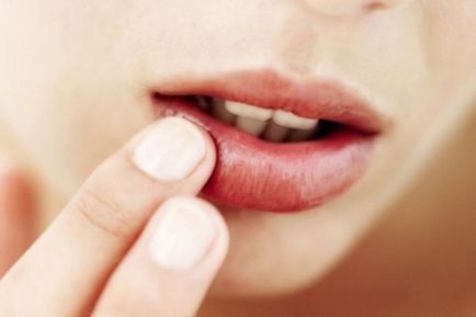 Tabletta Herpes az ajkak, az arc, vírusellenes gyógyszerek