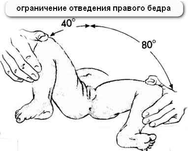 Тазостегновий суглоб дитини 1 місяць