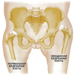 Тазостегновий суглоб дитини 1 місяць
