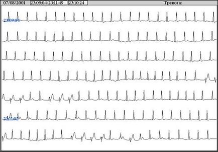 Tele-ecg monitorizare telemetrică eq în timp real, tredex