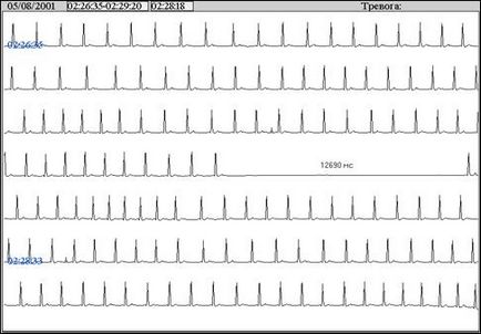 Tele-ecg monitorizare telemetrică eq în timp real, tredex