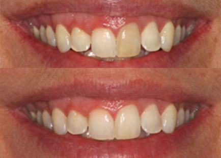 Тільки справжні відгуки про систему відбілювання зубів opalescence (опалесценс)!