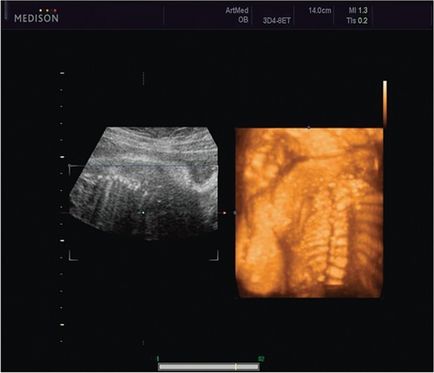 Diagnosticul ultrasonic al defectelor la nivelul coloanei vertebrale a fătului - mazirko m
