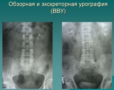 Урографія екскреторна, внутрішньовенна і підготовка до дослідження