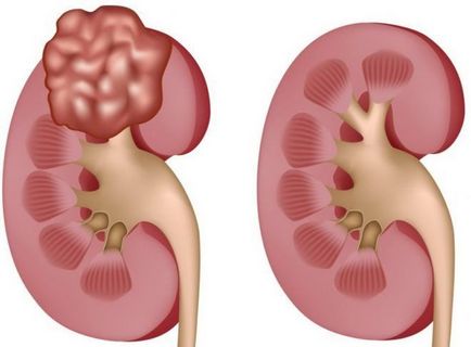 Exprimarea urologică, intravenoasă și pregătirea pentru studiu