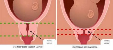 Gâtul îngust al nașterii uterine, uterul în timpul sarcinii