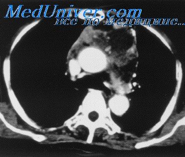 Nodular congestive goiter