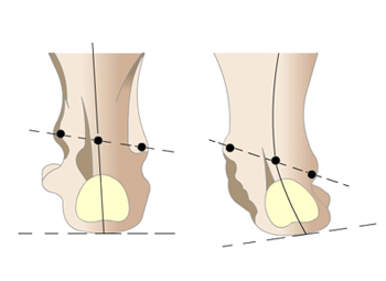 Valgus deformitás láb a gyermek okoz és kezelés