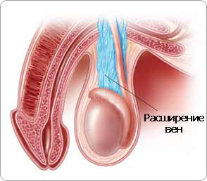 Varicocele simptome, cauze și tratament