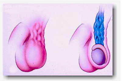 Varicocele tünetek, okok és a kezelés