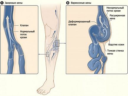 Varicele varice ale membrelor inferioare cauzează vene varicoase, simptome, complicații, însoțitoare