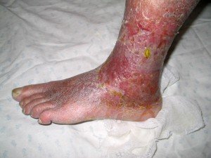 Varicele varice ale membrelor inferioare cauzează vene varicoase, simptome, complicații, însoțitoare