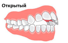Види прикусів патологічного і фізіологічного