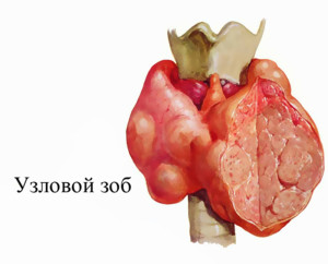 Види зоба щитовидної залози