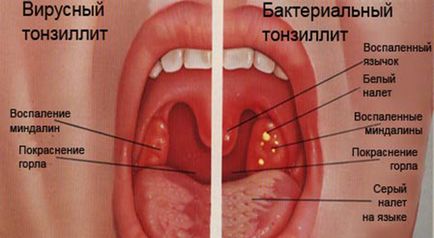 Vírusos mandulagyulladás - Tünetek, okok és a kezelés a