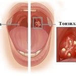 Вірусний тонзиліт - симптоми, причини появи і лікування