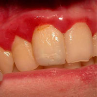 fogíny gyulladás után protézisek, a fogászati ​​kezelés