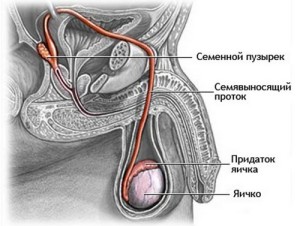 Запалення сім'яного канатика